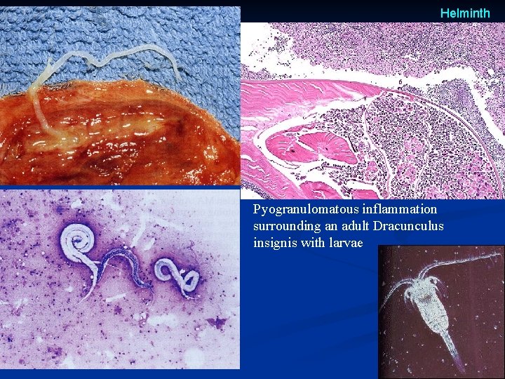 Helminth Pyogranulomatous inflammation surrounding an adult Dracunculus insignis with larvae Helminth Pyogranulomatous inflammation surrounding an adult Dracunculus insignis with larvae