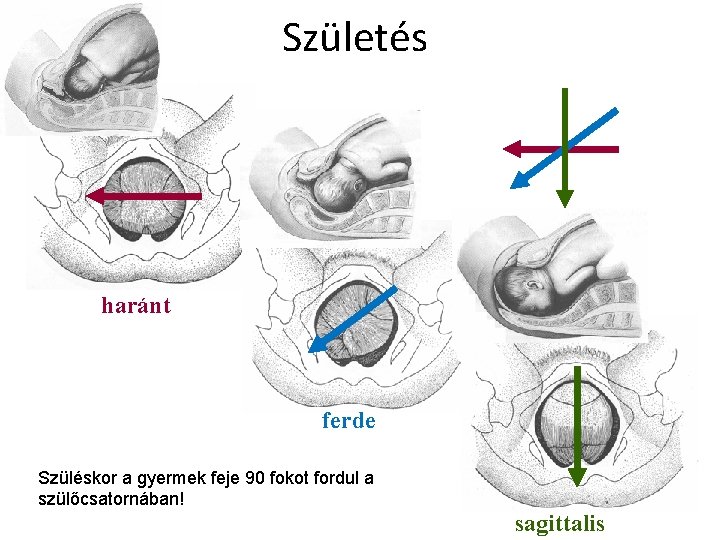 Születés haránt ferde Szüléskor a gyermek feje 90 fokot fordul a szülőcsatornában! sagittalis 