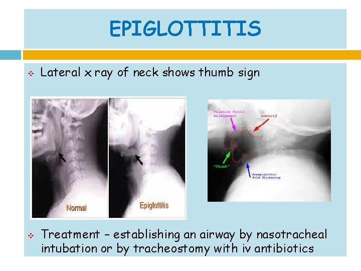 EPIGLOTTITIS v v Lateral x ray of neck shows thumb sign Treatment – establishing