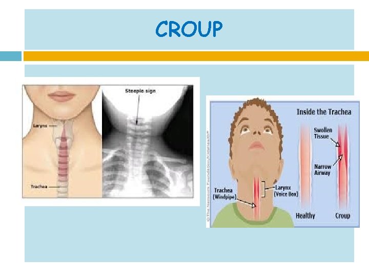 CROUP 