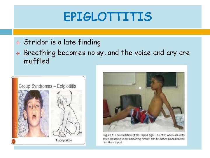 EPIGLOTTITIS v v Stridor is a late finding Breathing becomes noisy, and the voice