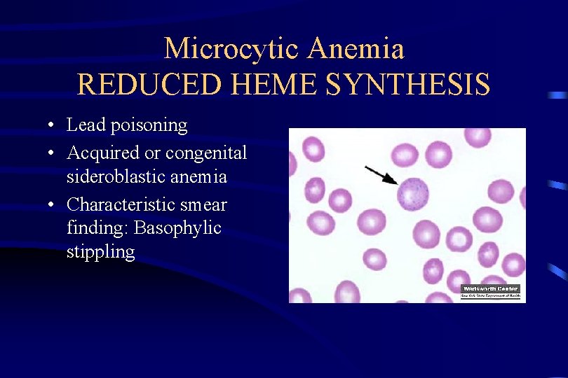 Microcytic Anemia REDUCED HEME SYNTHESIS • Lead poisoning • Acquired or congenital sideroblastic anemia