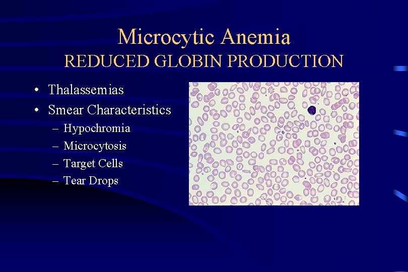 Microcytic Anemia REDUCED GLOBIN PRODUCTION • Thalassemias • Smear Characteristics – – Hypochromia Microcytosis