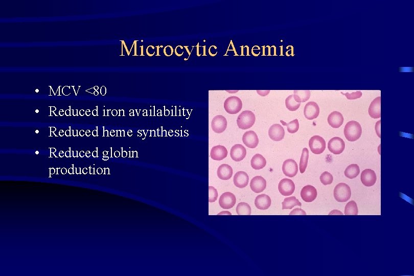 Microcytic Anemia • • MCV <80 Reduced iron availability Reduced heme synthesis Reduced globin