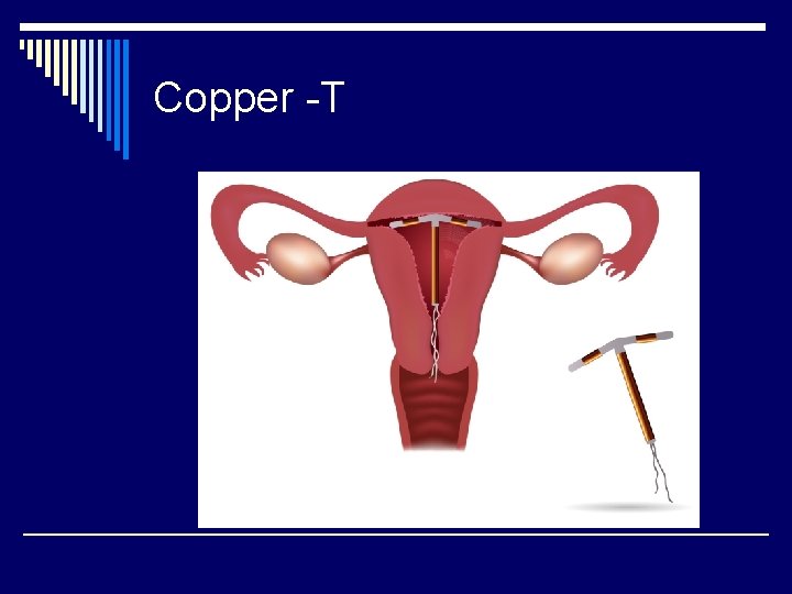 Copper -T 
