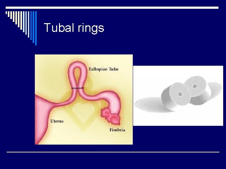 Tubal rings 