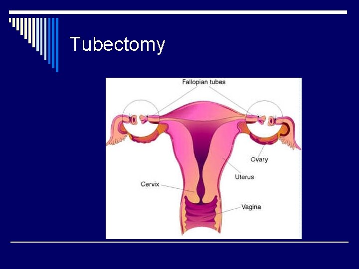 Tubectomy 