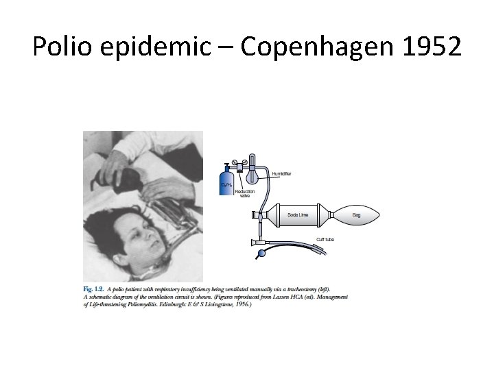 Polio epidemic – Copenhagen 1952 