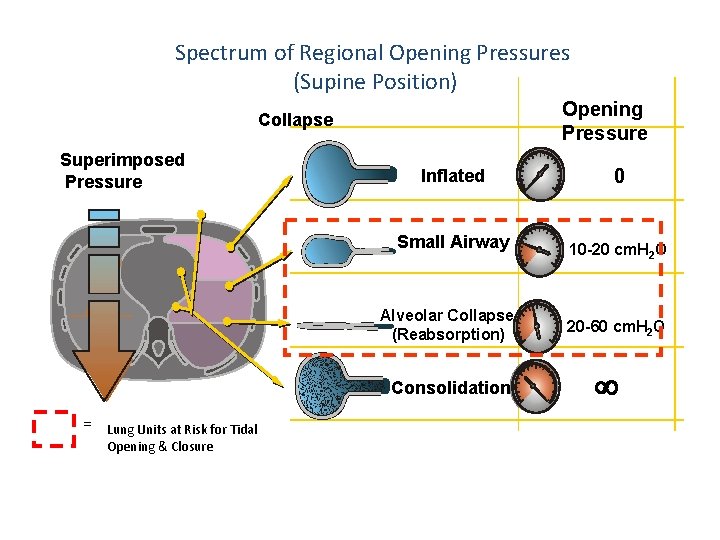 Spectrum of Regional Opening Pressures (Supine Position) Opening Pressure Collapse Superimposed Pressure Inflated Small