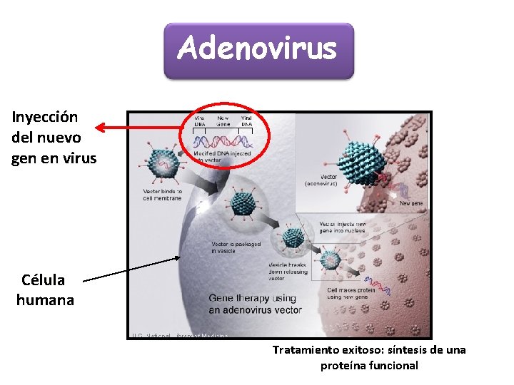 Adenovirus Inyección del nuevo gen en virus Célula humana Tratamiento exitoso: síntesis de una