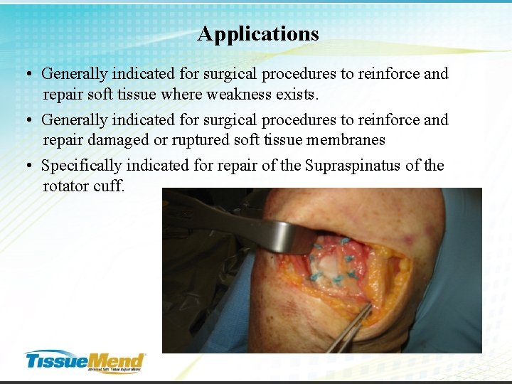Applications • Generally indicated for surgical procedures to reinforce and repair soft tissue where