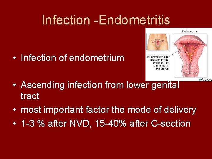 Infection -Endometritis • Infection of endometrium • Ascending infection from lower genital tract •