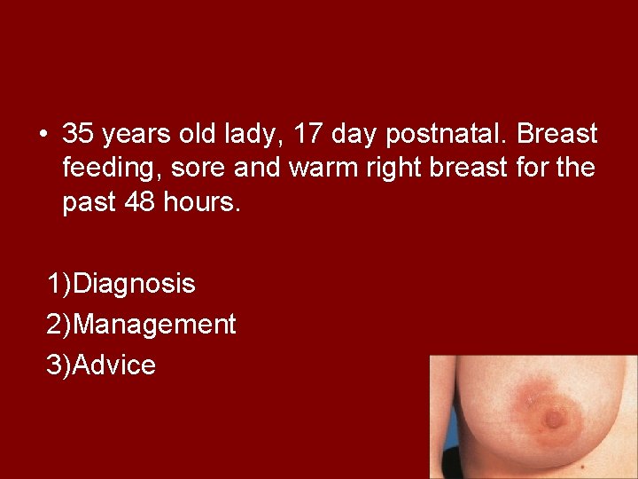 • 35 years old lady, 17 day postnatal. Breast feeding, sore and warm