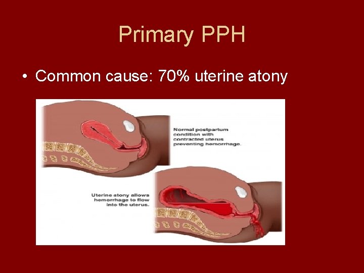 Primary PPH • Common cause: 70% uterine atony 