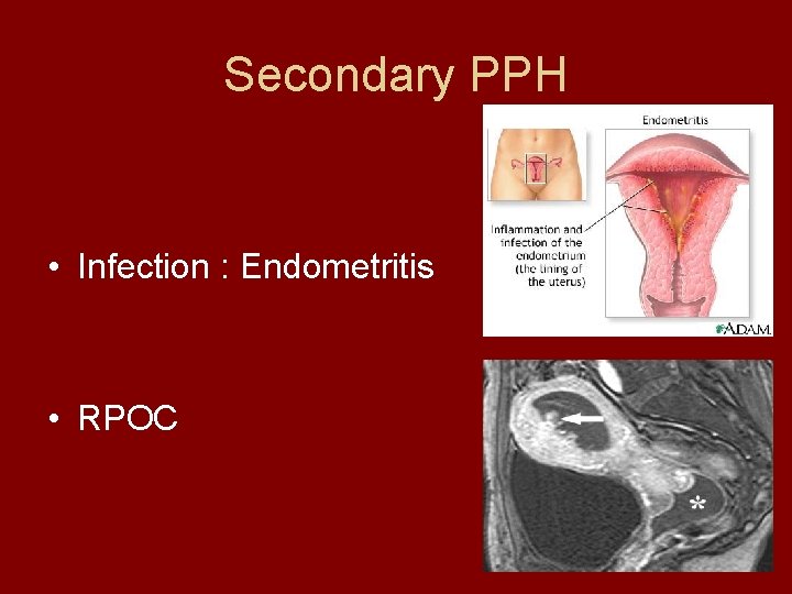 Secondary PPH • Infection : Endometritis • RPOC 