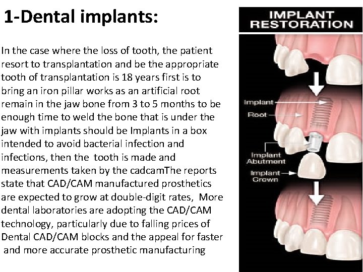 1 -Dental implants: In the case where the loss of tooth, the patient resort