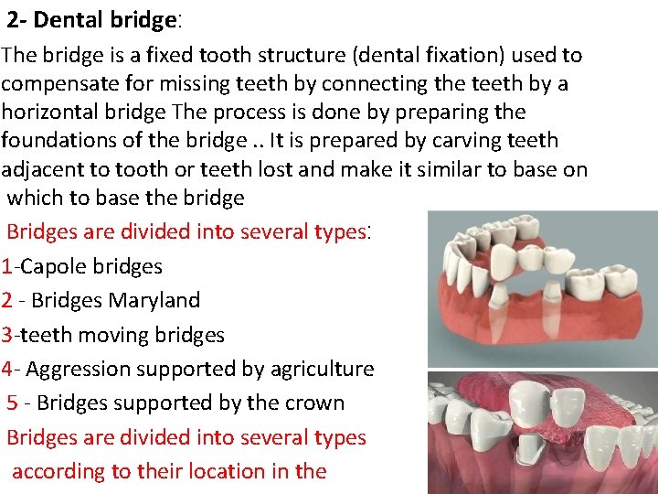 2 - Dental bridge: The bridge is a fixed tooth structure (dental fixation) used