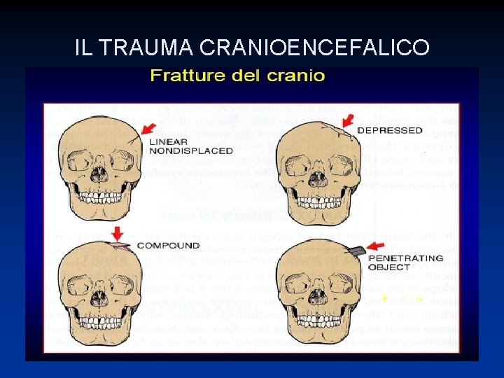 IL TRAUMA CRANIOENCEFALICO 