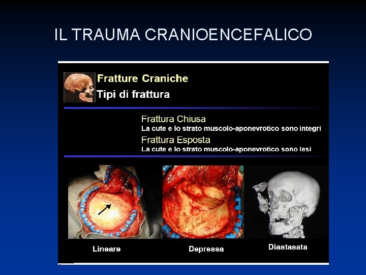 IL TRAUMA CRANIOENCEFALICO 