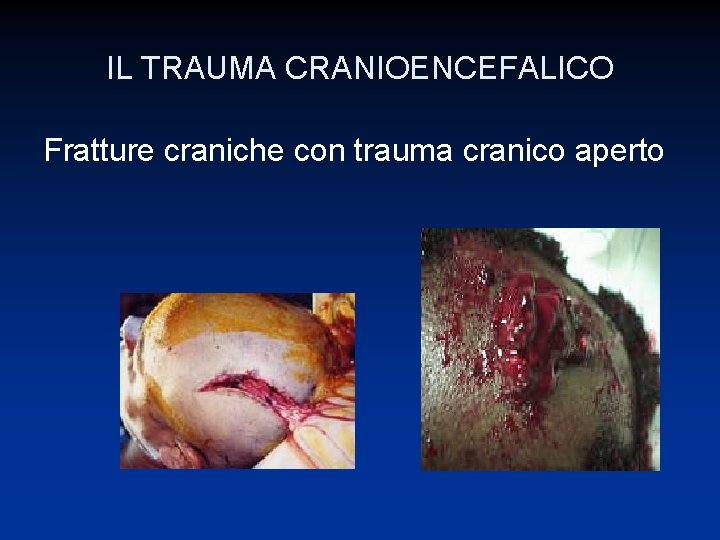 IL TRAUMA CRANIOENCEFALICO Fratture craniche con trauma cranico aperto 