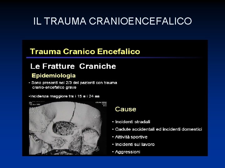 IL TRAUMA CRANIOENCEFALICO LE FRATTURE 