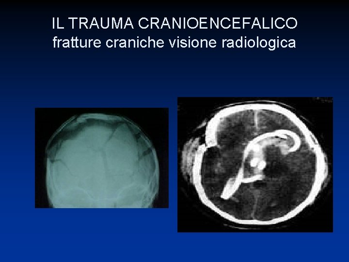 IL TRAUMA CRANIOENCEFALICO fratture craniche visione radiologica 