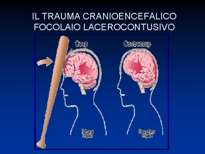 IL TRAUMA CRANIOENCEFALICO FOCOLAIO LACEROCONTUSIVO 