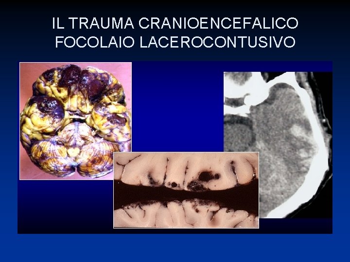 IL TRAUMA CRANIOENCEFALICO FOCOLAIO LACEROCONTUSIVO 
