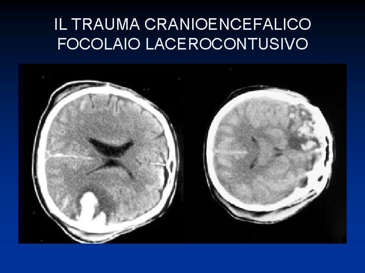 IL TRAUMA CRANIOENCEFALICO FOCOLAIO LACEROCONTUSIVO 
