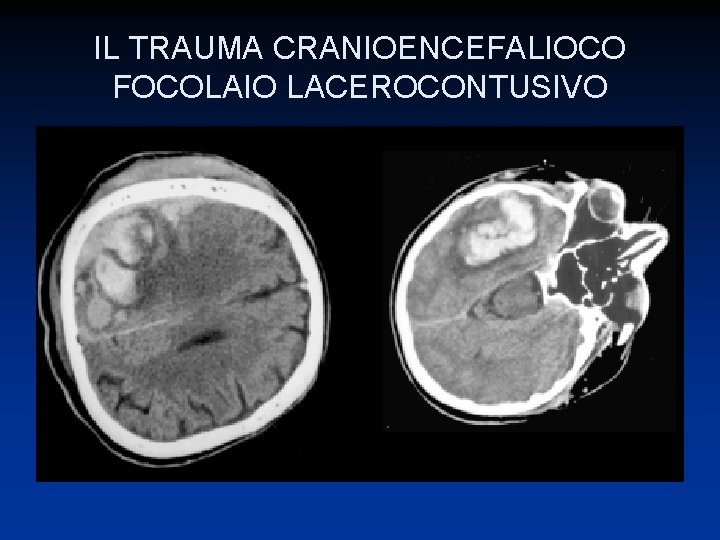 IL TRAUMA CRANIOENCEFALIOCO FOCOLAIO LACEROCONTUSIVO 