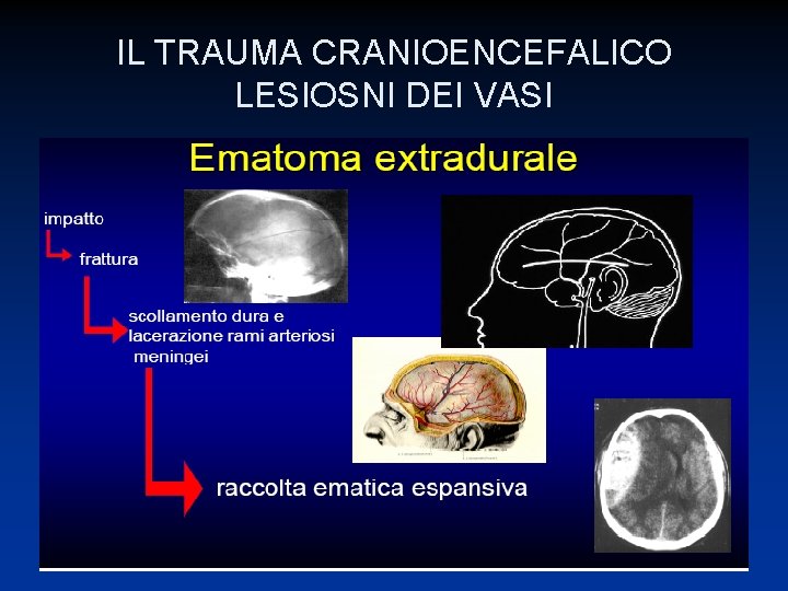 IL TRAUMA CRANIOENCEFALICO LESIOSNI DEI VASI 