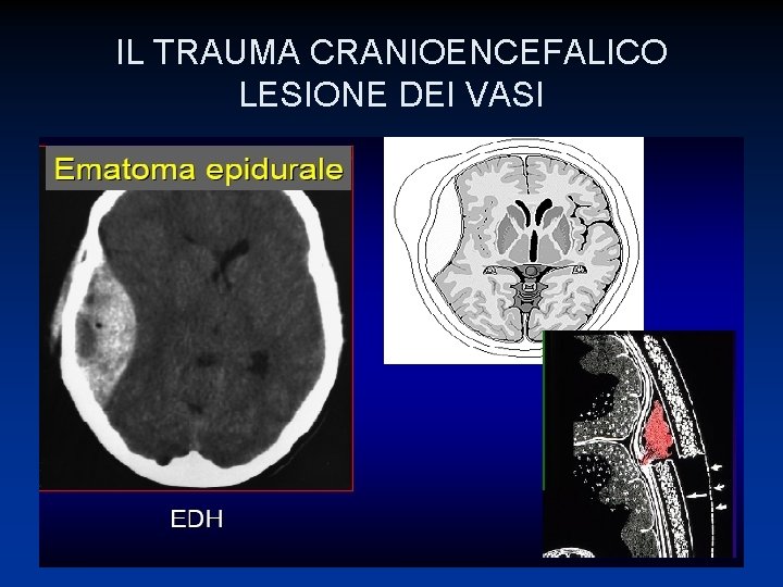 IL TRAUMA CRANIOENCEFALICO LESIONE DEI VASI 