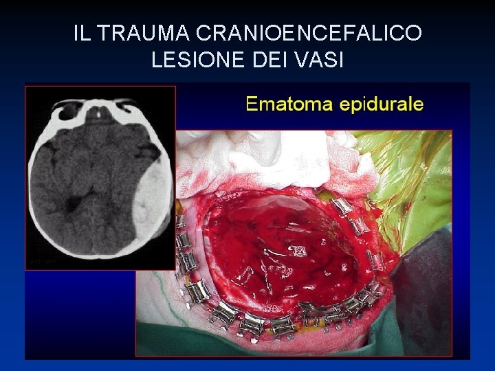 IL TRAUMA CRANIOENCEFALICO LESIONE DEI VASI 