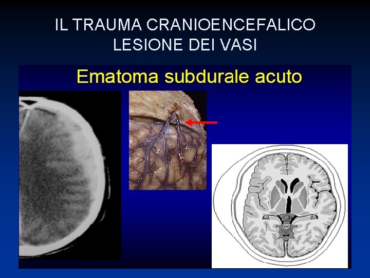 IL TRAUMA CRANIOENCEFALICO LESIONE DEI VASI 