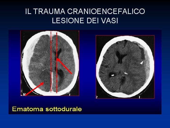 IL TRAUMA CRANIOENCEFALICO LESIONE DEI VASI 