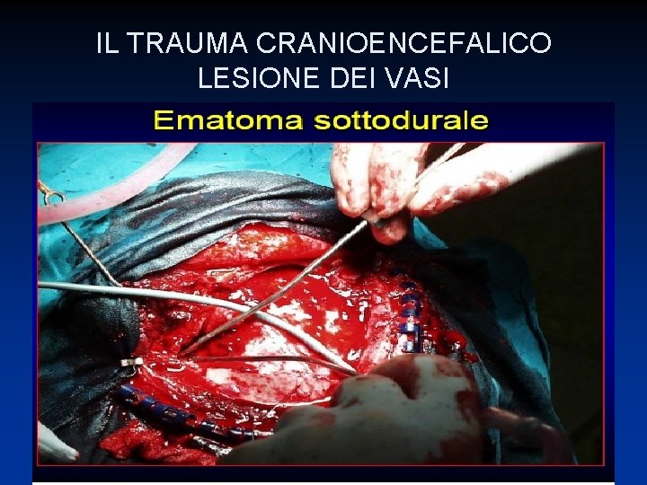 IL TRAUMA CRANIOENCEFALICO LESIONE DEI VASI 