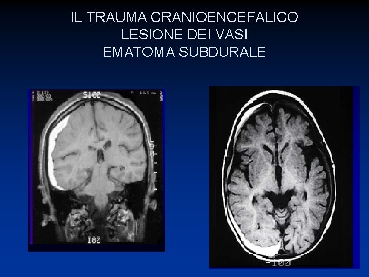 IL TRAUMA CRANIOENCEFALICO LESIONE DEI VASI EMATOMA SUBDURALE 