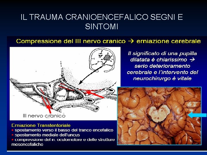IL TRAUMA CRANIOENCEFALICO SEGNI E SINTOMI 