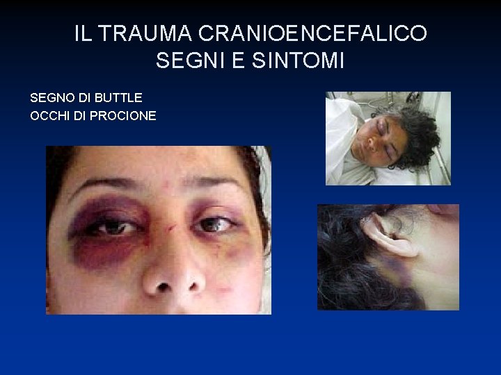 IL TRAUMA CRANIOENCEFALICO SEGNI E SINTOMI SEGNO DI BUTTLE OCCHI DI PROCIONE 