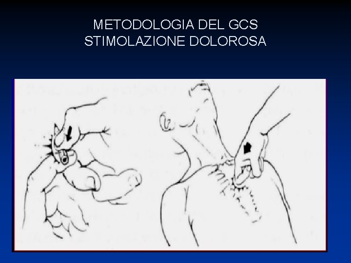 METODOLOGIA DEL GCS STIMOLAZIONE DOLOROSA 