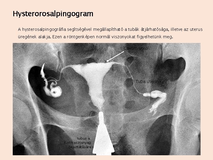 Hysterorosalpingogram A hysterosalpingográfia segítségével megállapítható a tubák átjárhatósága, illetve az uterus üregének alakja. Ezen