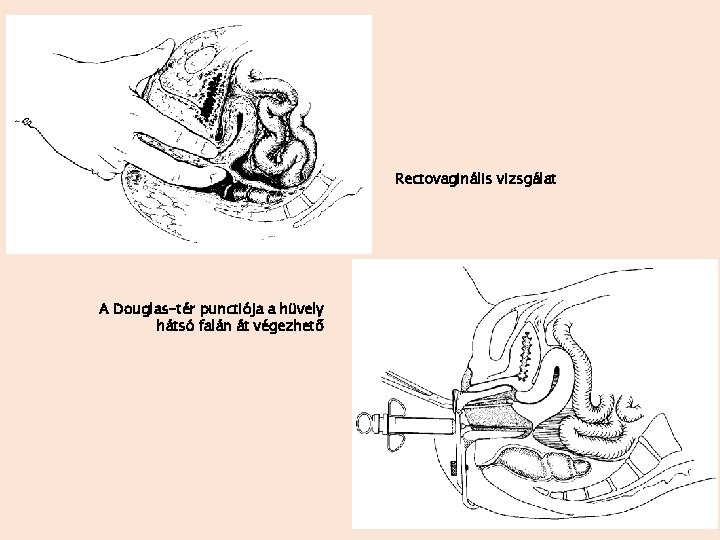 Rectovaginális vizsgálat A Douglas-tér punctiója a hüvely hátsó falán át végezhető 