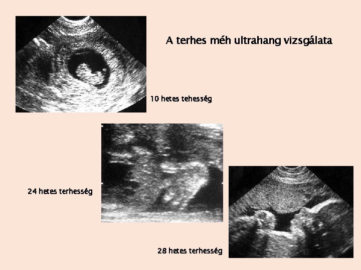 A terhes méh ultrahang vizsgálata 10 hetes tehesség 24 hetes terhesség 28 hetes terhesség