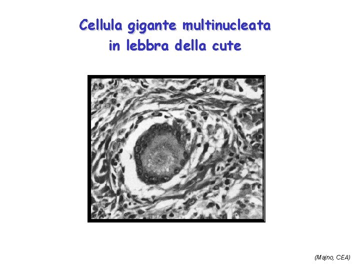 Cellula gigante multinucleata in lebbra della cute (Majno, CEA) 