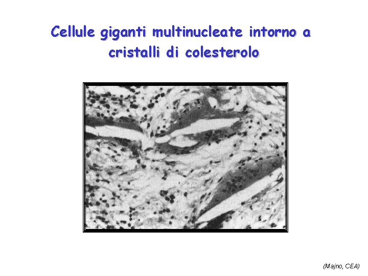 Cellule giganti multinucleate intorno a cristalli di colesterolo (Majno, CEA) 