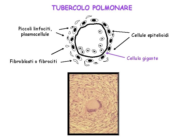 TUBERCOLO POLMONARE Piccoli linfociti, plasmacellule Fibroblasti o fibrociti Cellule epitelioidi Cellula gigante 