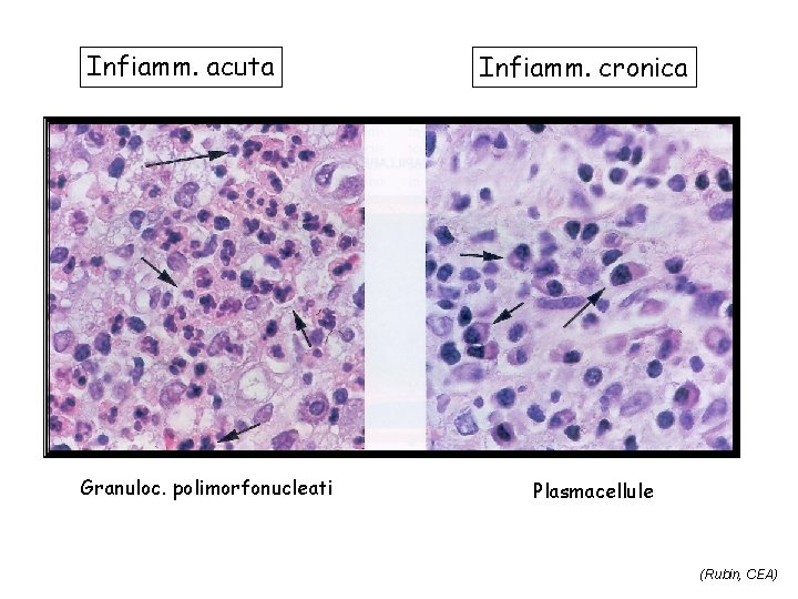 Infiamm. acuta Granuloc. polimorfonucleati Infiamm. cronica Plasmacellule (Rubin, CEA) 