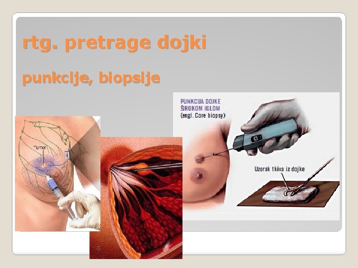 rtg. pretrage dojki punkcije, biopsije rtg. pretrage dojki punkcije, biopsije