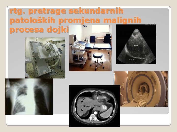 rtg. pretrage sekundarnih patoloških promjena malignih procesa dojki rtg. pretrage sekundarnih patoloških promjena malignih procesa dojki