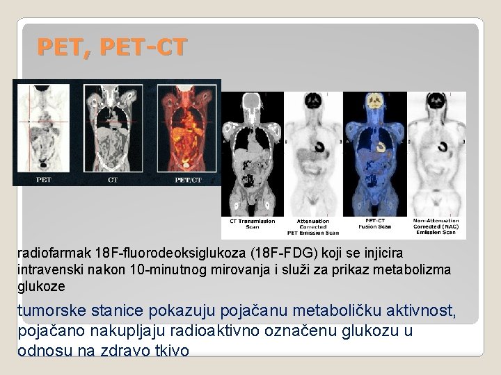 PET, PET-CT radiofarmak 18 F-fluorodeoksiglukoza (18 F-FDG) koji se injicira intravenski nakon 10 -minutnog PET, PET-CT radiofarmak 18 F-fluorodeoksiglukoza (18 F-FDG) koji se injicira intravenski nakon 10 -minutnog